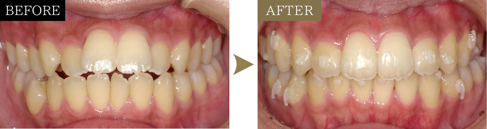 出っ歯と開咬を矯正治療で改善した症例のビフォーアフター