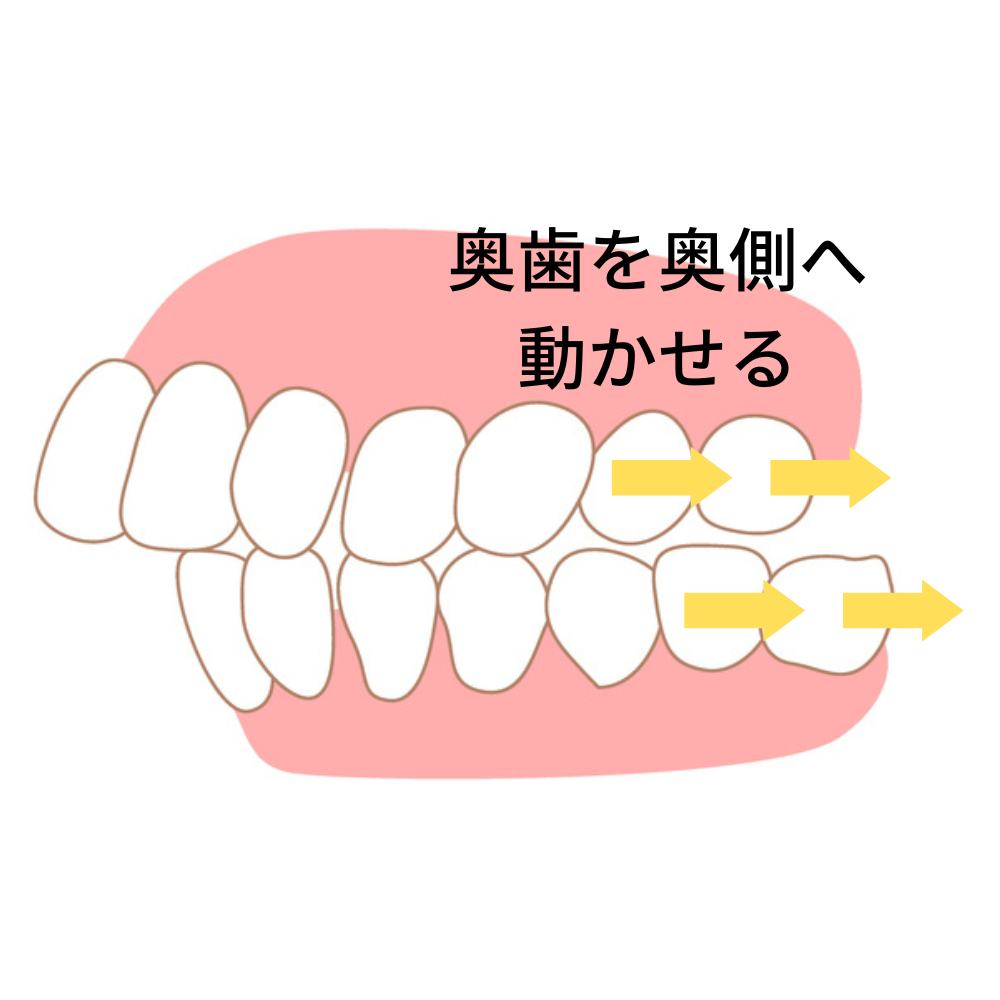 マウスピース矯正だけでは治せない場合がある