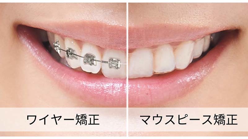 インビザラインとワイヤー矯正の装置のイメージ写真