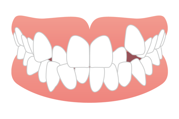 歯が重なり合って生えている叢生・乱杭歯（ガチャ歯）のイラスト