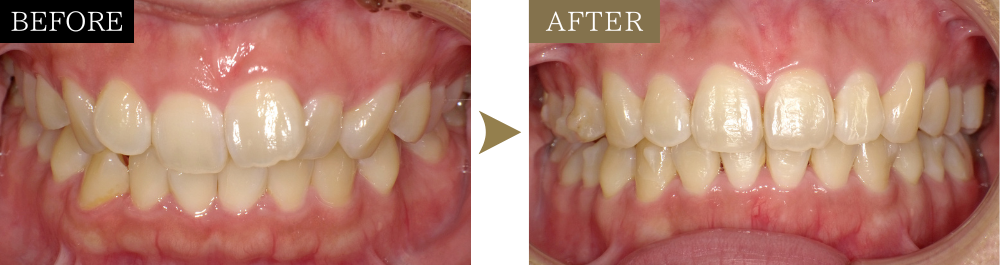 出っ歯の治療前後比較写真（正面）