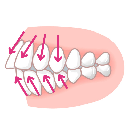 ＡＩの言うまま非抜歯矯正
