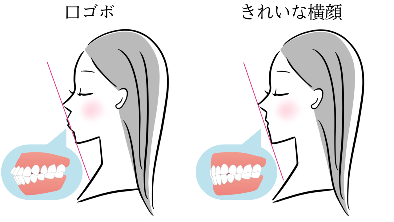 矯正治療で口ゴボになった