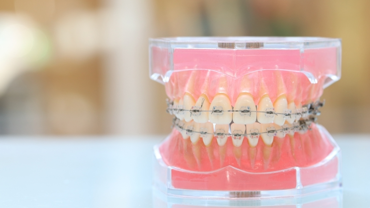 ワイヤー矯正装置