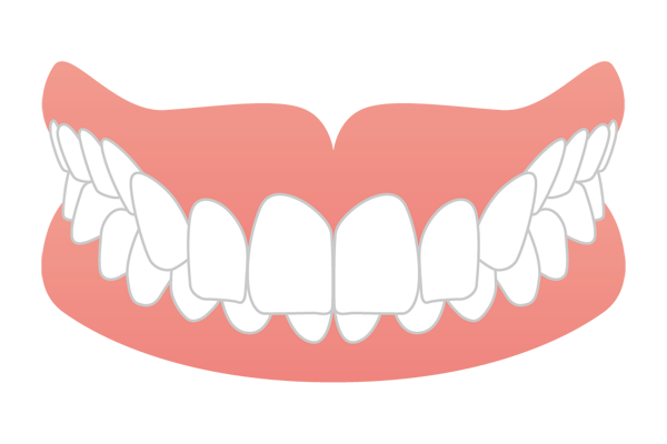 噛み合わせが深い過蓋咬合（ディープバイト）のイラスト