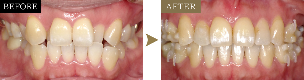 叢生を矯正治療で改善した症例のビフォーアフター