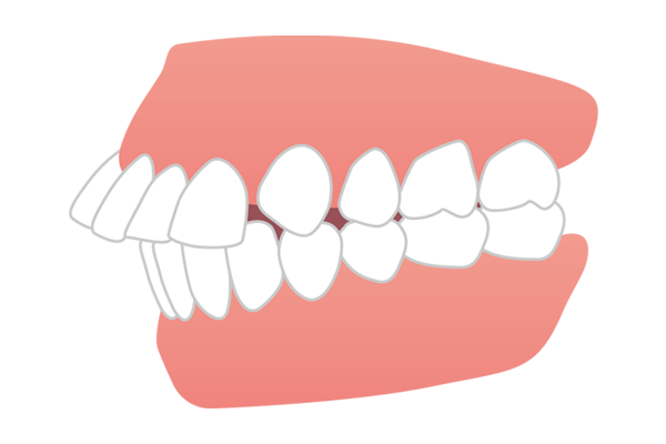 上の前歯が突出している出っ歯（上顎前突）のイラスト