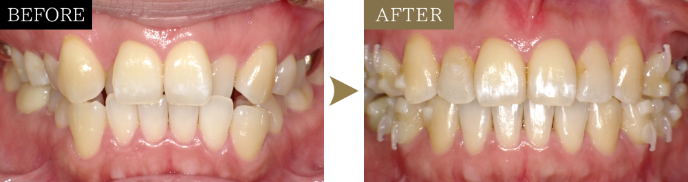 叢生の治療前後比較写真（正面）