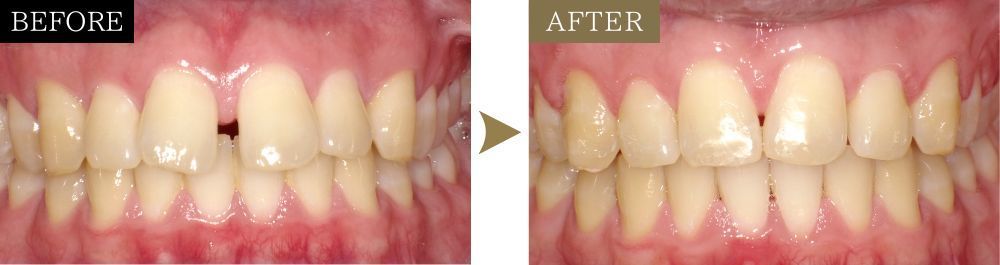 すきっ歯を矯正治療で改善した症例のビフォーアフター