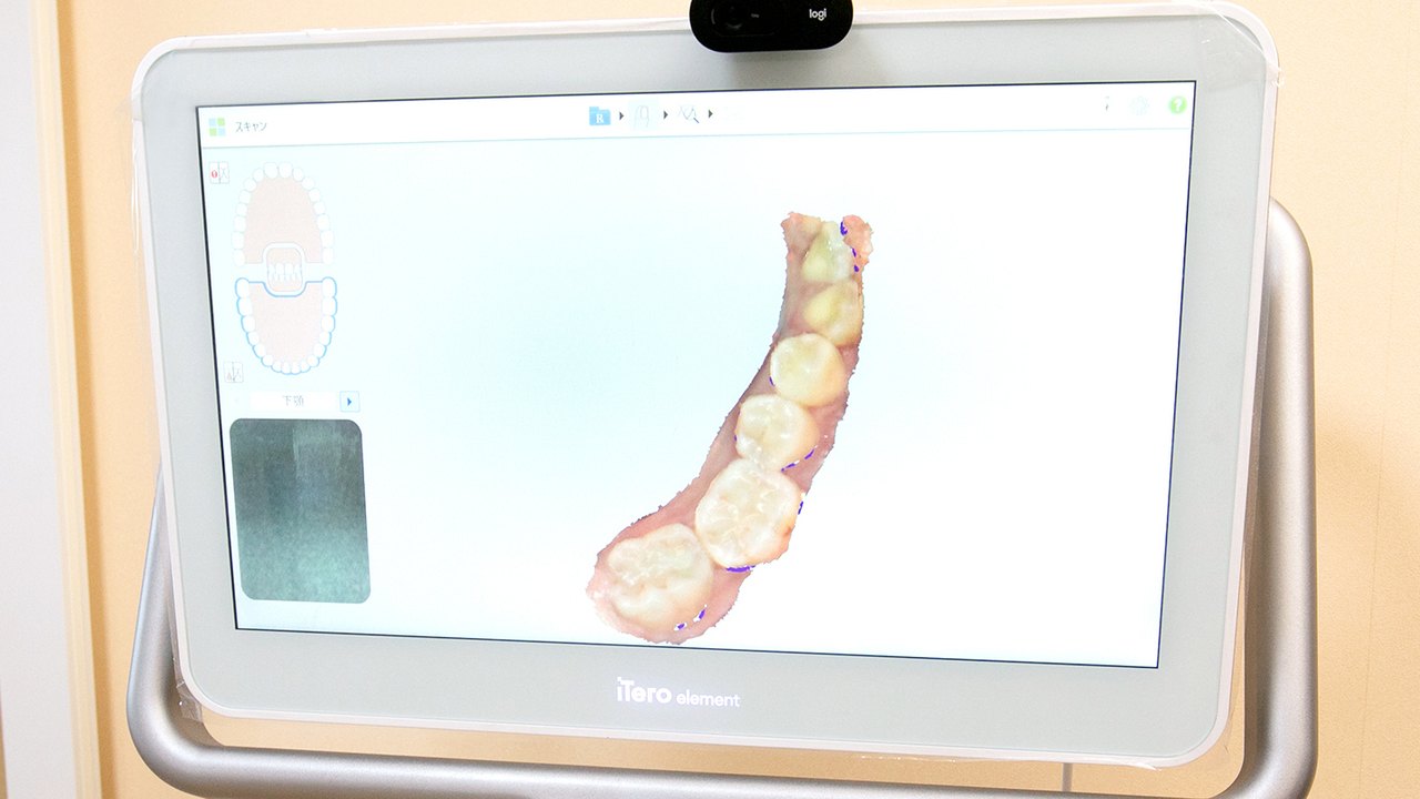 口腔内スキャナー「iTero」を使ったお口のデータのスキャン