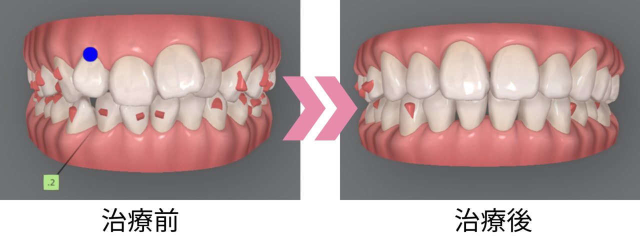 矯正前後での歯並びの変化がわかるシミュレーション画像