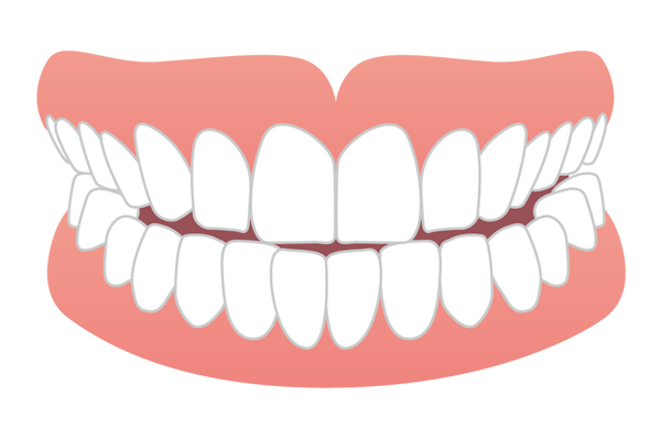 上下の前歯が先端同士で当たる切端咬合のイラスト